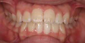 終了時　の歯並び