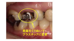 銀歯の加工