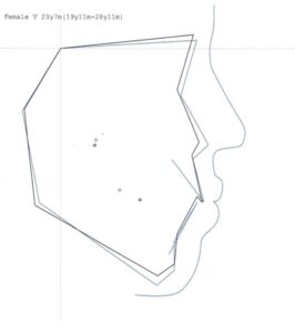 プロフィログラム